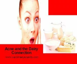 Acne And Its Dairy Connection